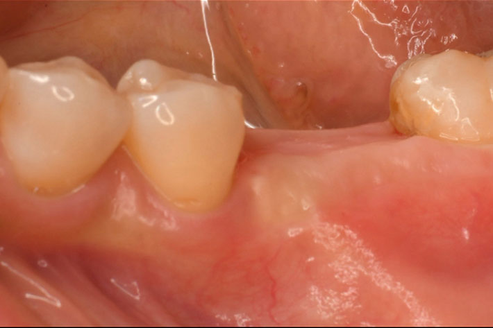 インプラント症例。国分寺の歯医者　こばやし歯科