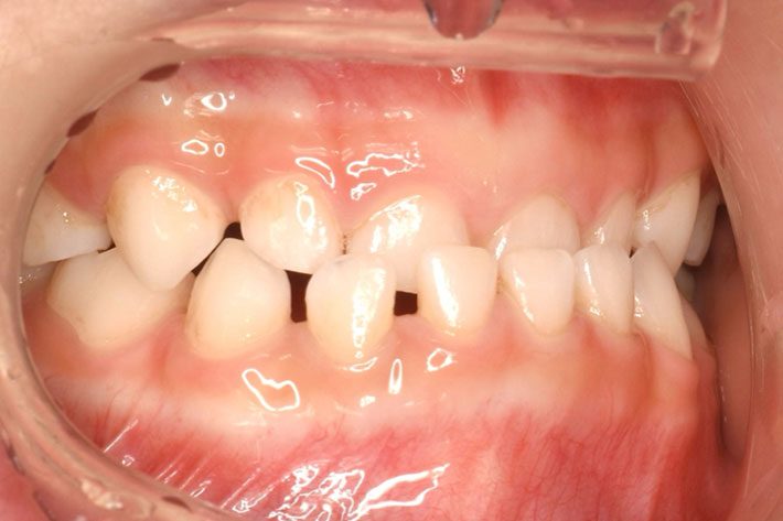 子どもの歯並びの症例。国分寺の歯医者　こばやし歯科